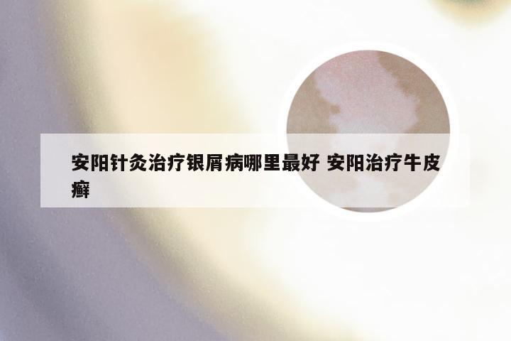 安阳针灸治疗银屑病哪里最好 安阳治疗牛皮癣