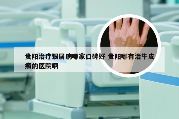 贵阳治疗银屑病哪家口碑好 贵阳哪有治牛皮癣的医院啊
