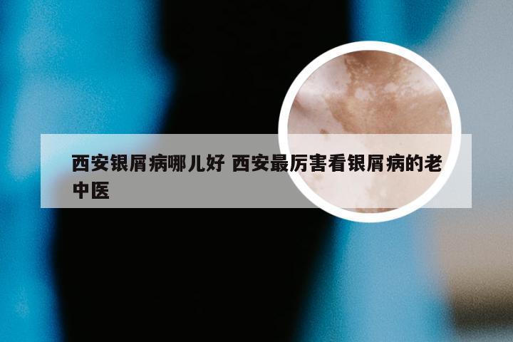 西安银屑病哪儿好 西安最厉害看银屑病的老中医