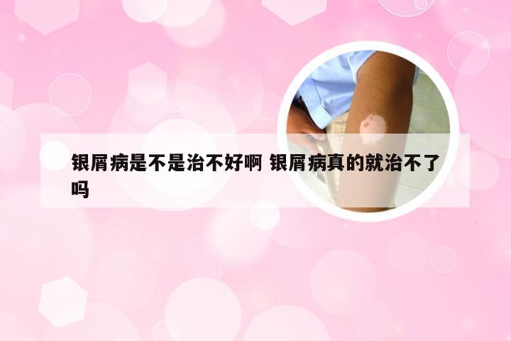 银屑病是不是治不好啊 银屑病真的就治不了吗