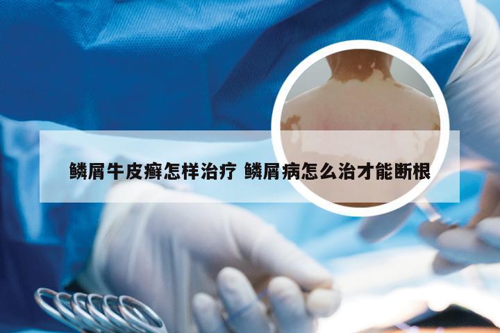 鳞屑牛皮癣怎样治疗 鳞屑病怎么治才能断根