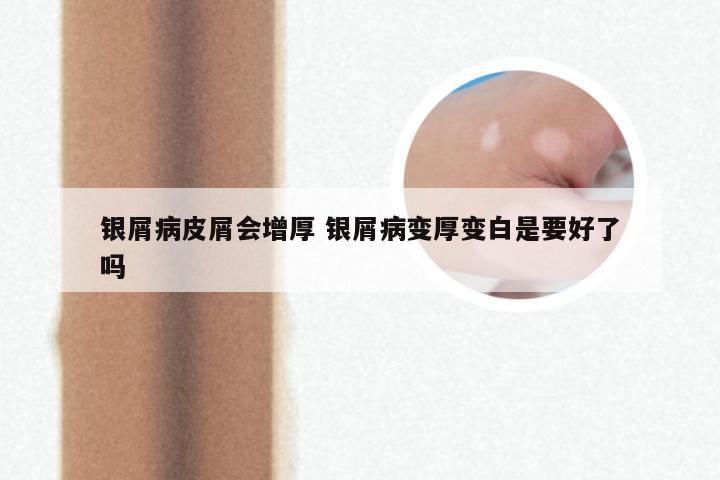 银屑病皮屑会增厚 银屑病变厚变白是要好了吗