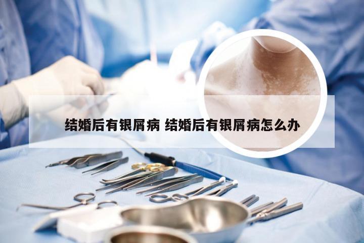 结婚后有银屑病 结婚后有银屑病怎么办