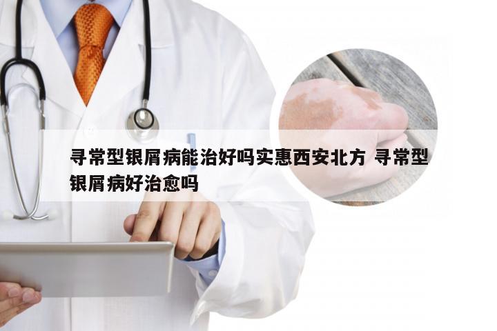 寻常型银屑病能治好吗实惠西安北方 寻常型银屑病好治愈吗