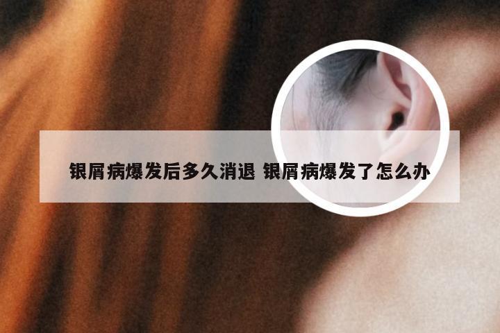 银屑病爆发后多久消退 银屑病爆发了怎么办