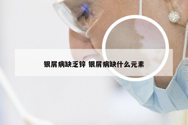 银屑病缺乏锌 银屑病缺什么元素