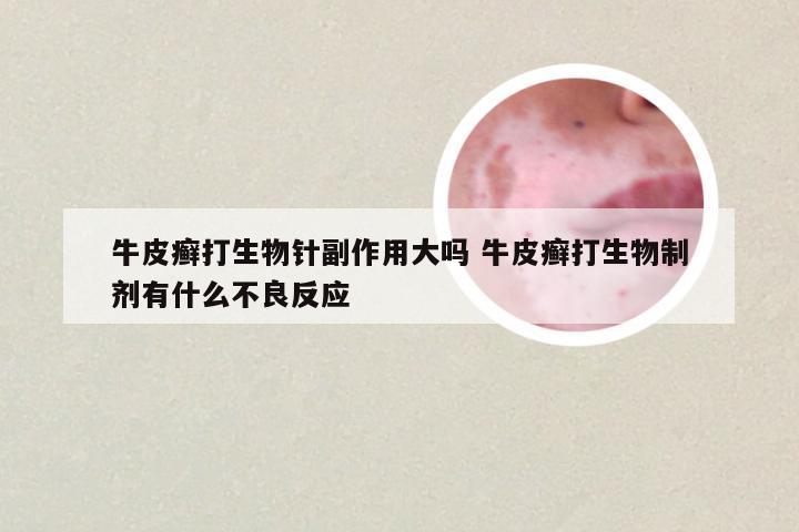 牛皮癣打生物针副作用大吗 牛皮癣打生物制剂有什么不良反应