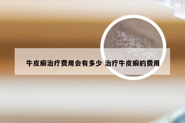 牛皮癣治疗费用会有多少 治疗牛皮癣的费用