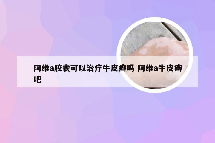 阿维a胶囊可以治疗牛皮癣吗 阿维a牛皮癣吧