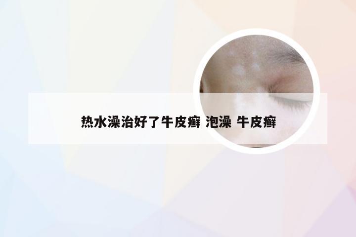 热水澡治好了牛皮癣 泡澡 牛皮癣
