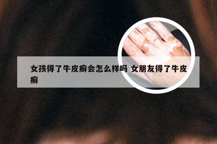 女孩得了牛皮癣会怎么样吗 女朋友得了牛皮癣