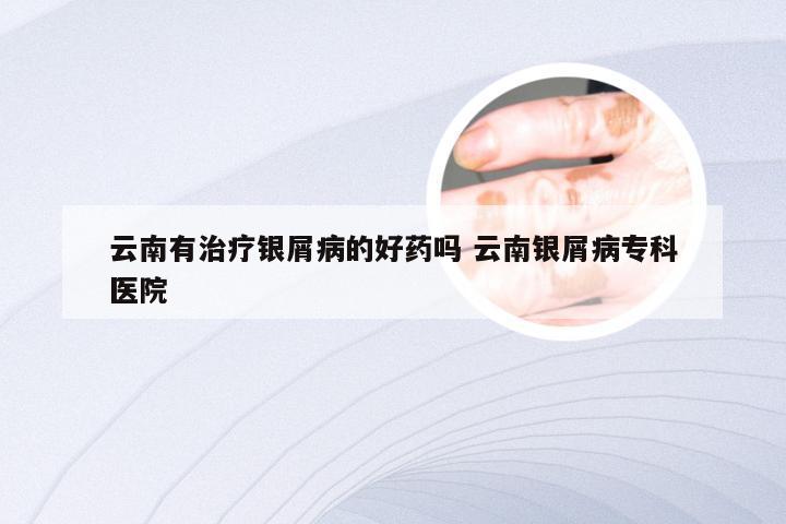 云南有治疗银屑病的好药吗 云南银屑病专科医院