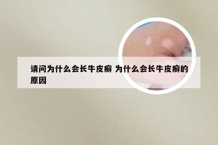 请问为什么会长牛皮癣 为什么会长牛皮癣的原因