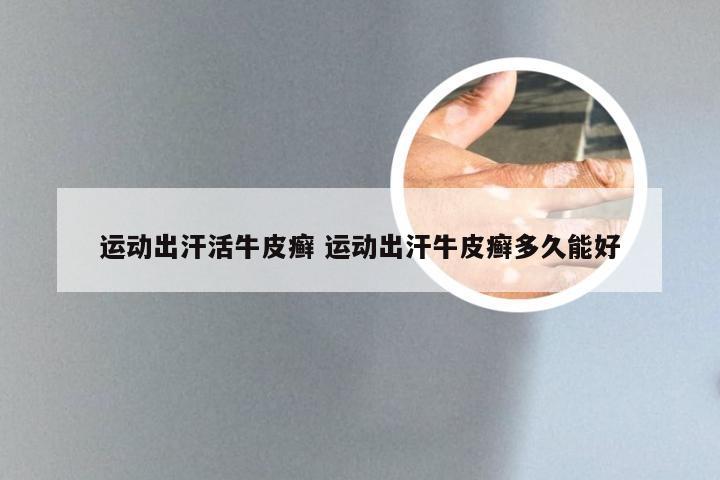 运动出汗活牛皮癣 运动出汗牛皮癣多久能好