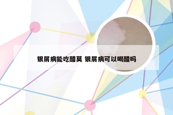 银屑病能吃醋莫 银屑病可以喝醋吗
