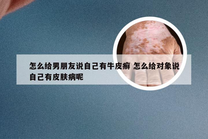 怎么给男朋友说自己有牛皮癣 怎么给对象说自己有皮肤病呢