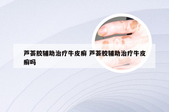 芦荟胶辅助治疗牛皮癣 芦荟胶辅助治疗牛皮癣吗