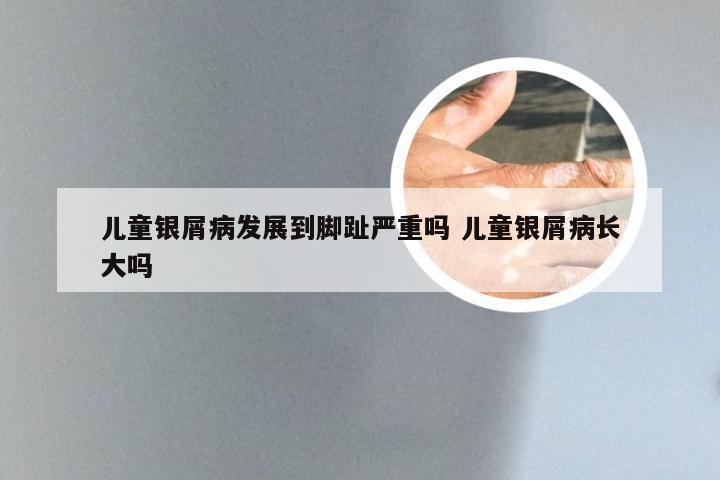 儿童银屑病发展到脚趾严重吗 儿童银屑病长大吗