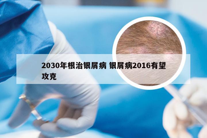 2030年根治银屑病 银屑病2016有望攻克
