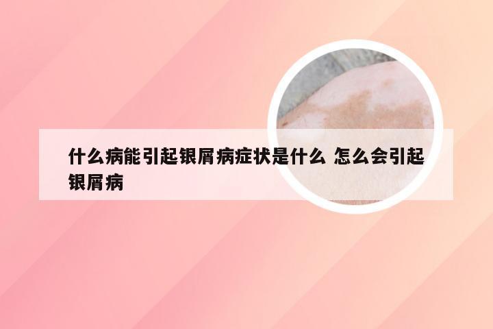 什么病能引起银屑病症状是什么 怎么会引起银屑病