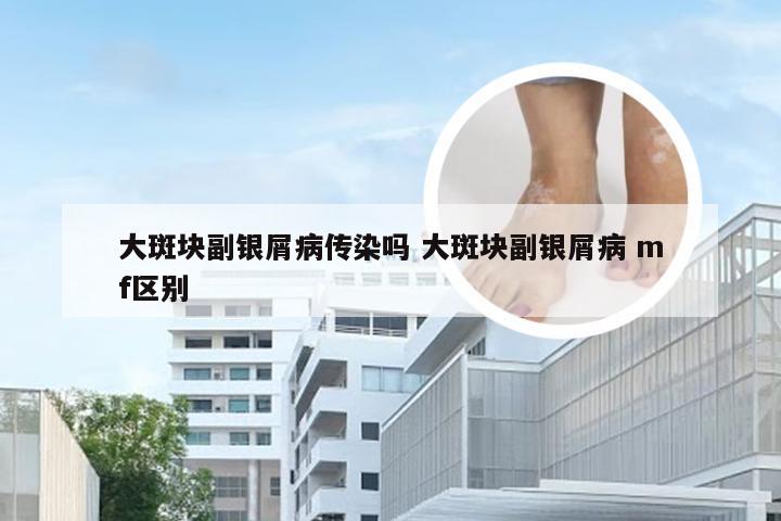 大斑块副银屑病传染吗 大斑块副银屑病 mf区别