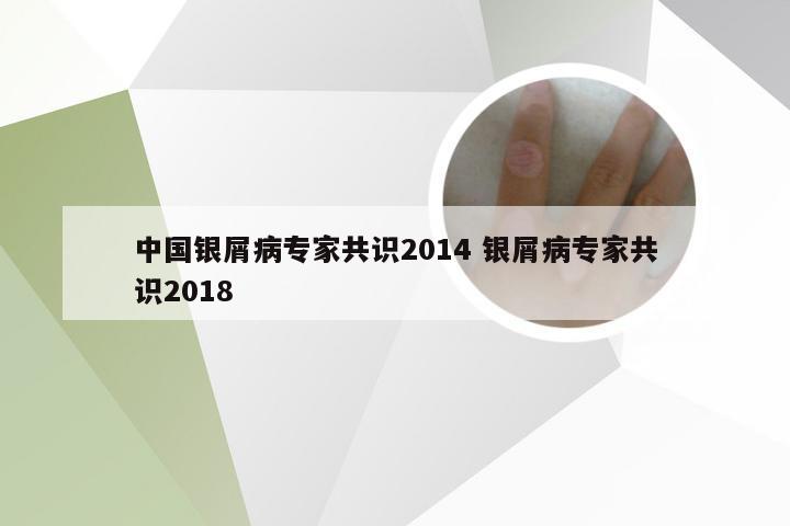 中国银屑病专家共识2014 银屑病专家共识2018