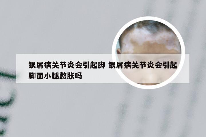 银屑病关节炎会引起脚 银屑病关节炎会引起脚面小腿憋胀吗