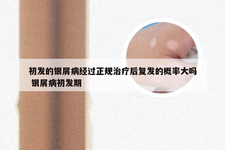 初发的银屑病经过正规治疗后复发的概率大吗 银屑病初发期