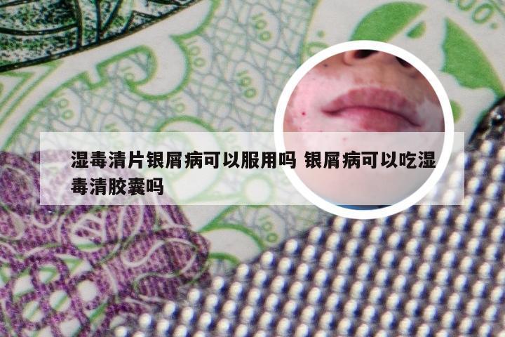 湿毒清片银屑病可以服用吗 银屑病可以吃湿毒清胶囊吗