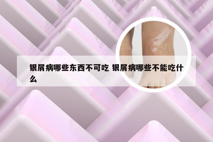 银屑病哪些东西不可吃 银屑病哪些不能吃什么