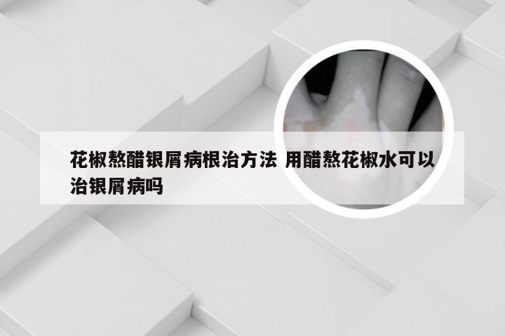 花椒熬醋银屑病根治方法 用醋熬花椒水可以治银屑病吗