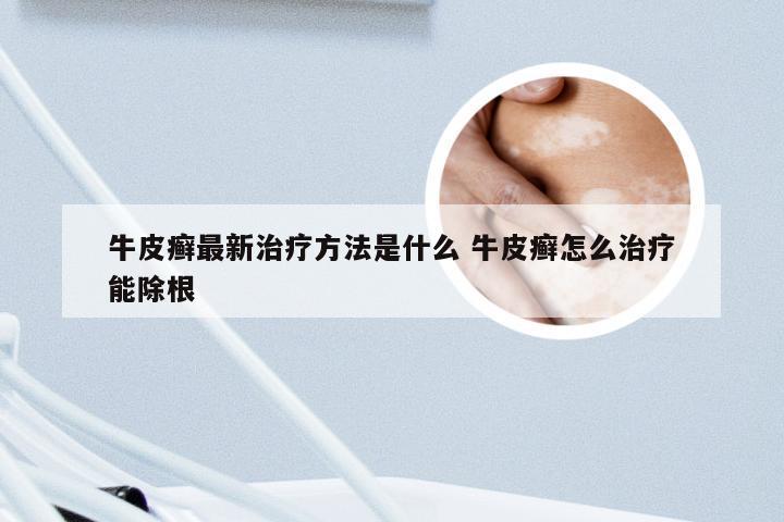 牛皮癣最新治疗方法是什么 牛皮癣怎么治疗能除根