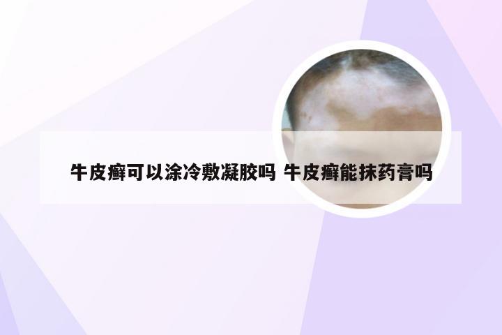 牛皮癣可以涂冷敷凝胶吗 牛皮癣能抹药膏吗