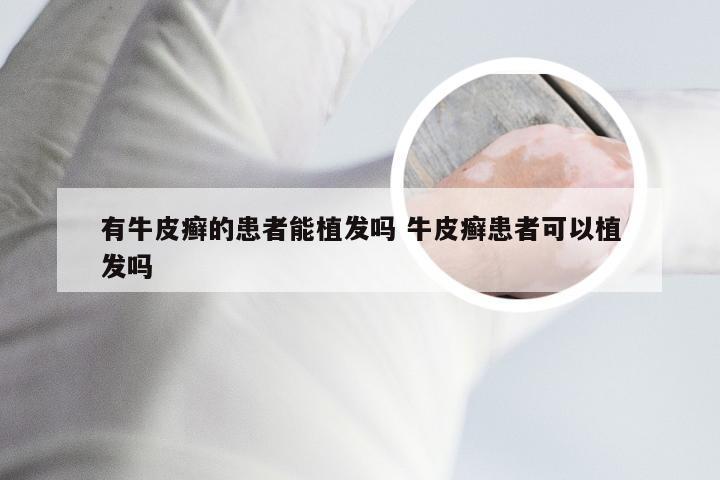 有牛皮癣的患者能植发吗 牛皮癣患者可以植发吗