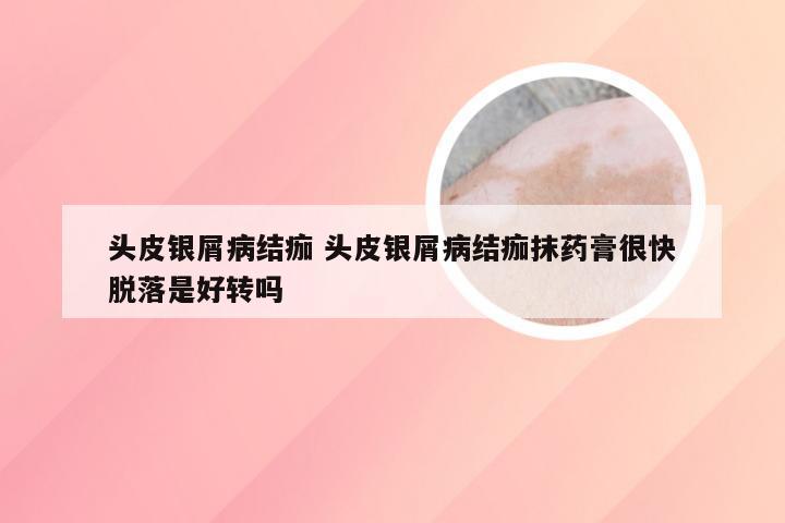 头皮银屑病结痂 头皮银屑病结痂抹药膏很快脱落是好转吗