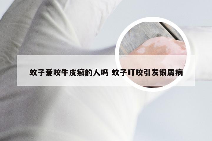 蚊子爱咬牛皮癣的人吗 蚊子叮咬引发银屑病