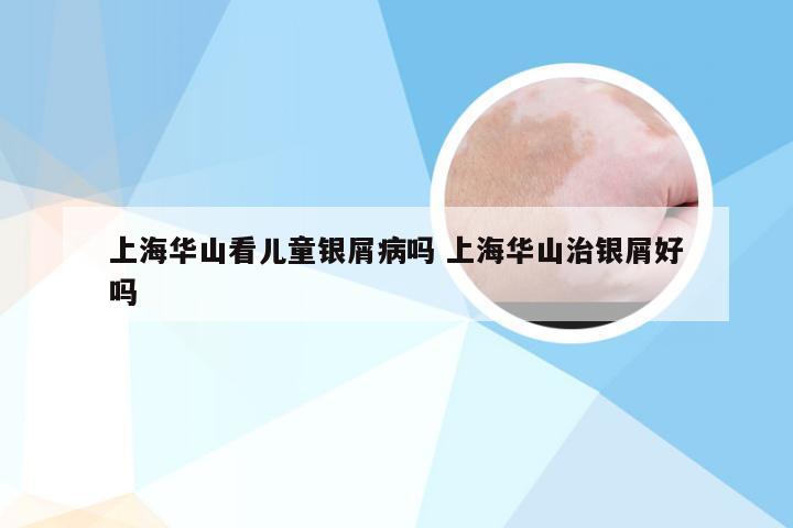 上海华山看儿童银屑病吗 上海华山治银屑好吗