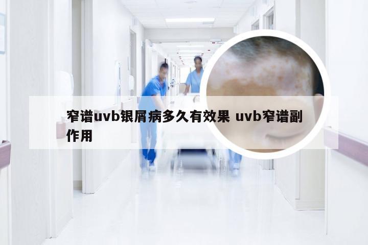窄谱uvb银屑病多久有效果 uvb窄谱副作用