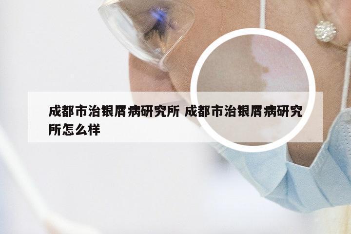 成都市治银屑病研究所 成都市治银屑病研究所怎么样