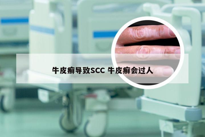 牛皮癣导致SCC 牛皮癣会过人