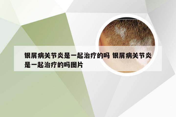 银屑病关节炎是一起治疗的吗 银屑病关节炎是一起治疗的吗图片