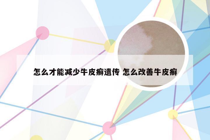 怎么才能减少牛皮癣遗传 怎么改善牛皮癣