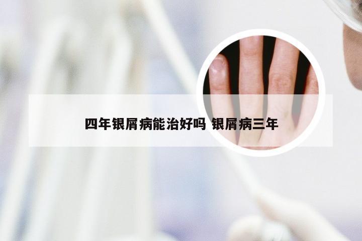 四年银屑病能治好吗 银屑病三年