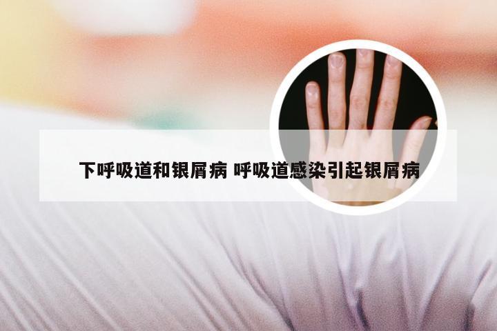 下呼吸道和银屑病 呼吸道感染引起银屑病