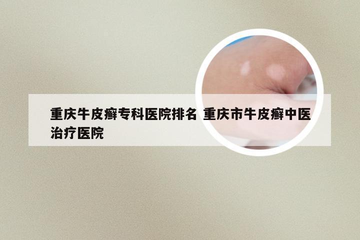 重庆牛皮癣专科医院排名 重庆市牛皮癣中医治疗医院