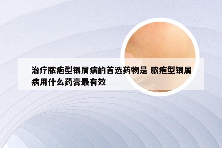 治疗脓疱型银屑病的首选药物是 脓疱型银屑病用什么药膏最有效