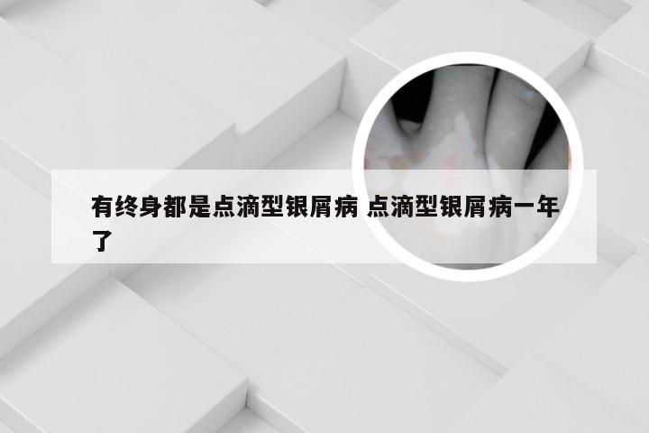 有终身都是点滴型银屑病 点滴型银屑病一年了