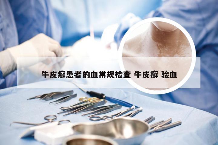 牛皮癣患者的血常规检查 牛皮癣 验血