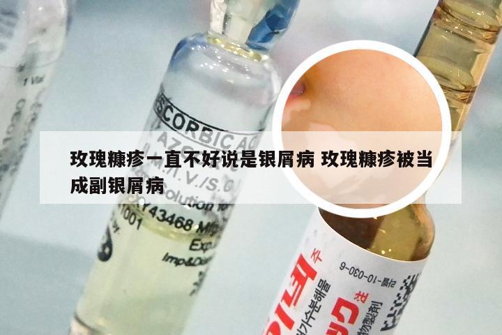 玫瑰糠疹一直不好说是银屑病 玫瑰糠疹被当成副银屑病