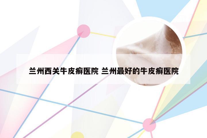 兰州西关牛皮癣医院 兰州最好的牛皮癣医院